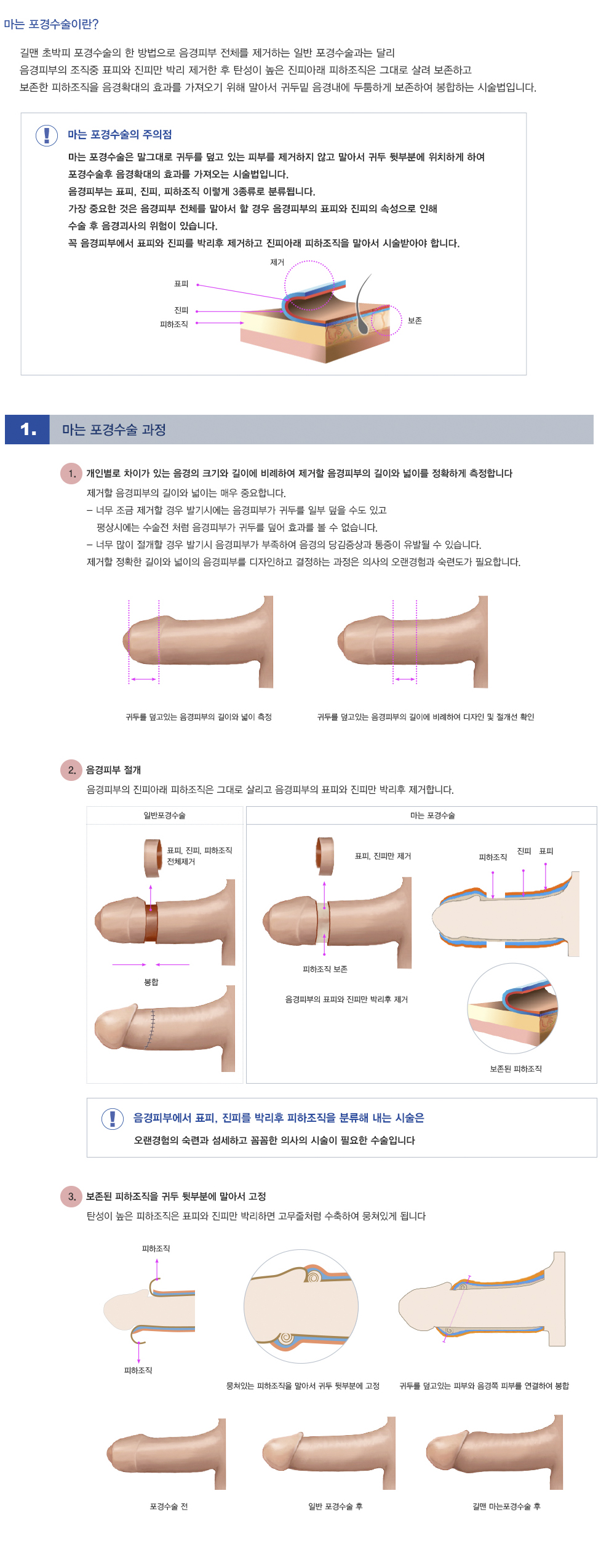 마는포경수술